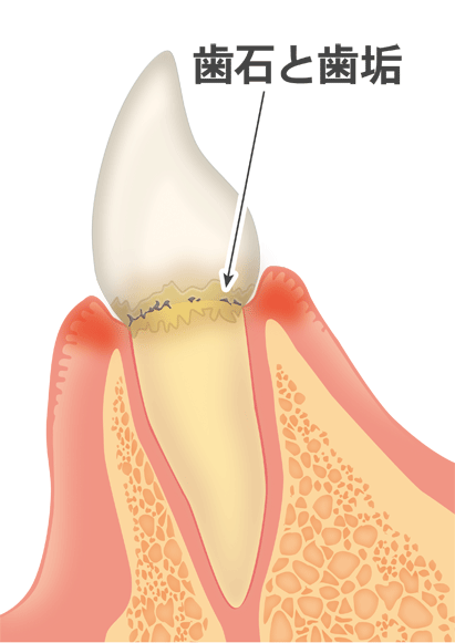 歯肉炎