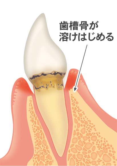 軽度の歯周病