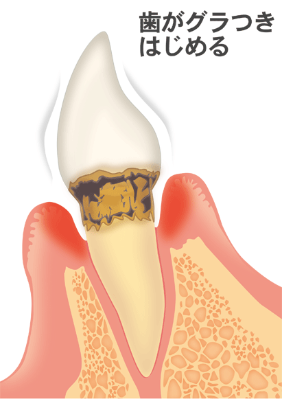 中等度の歯周病