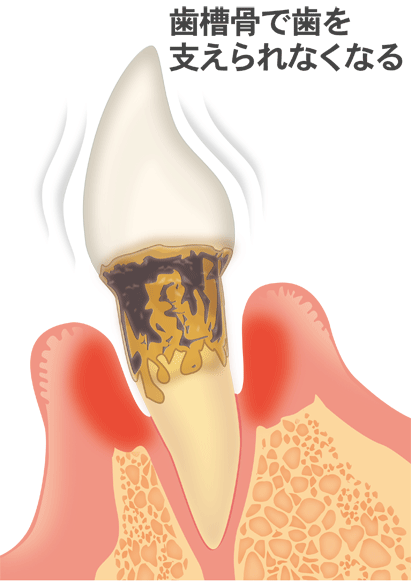重度の歯周病